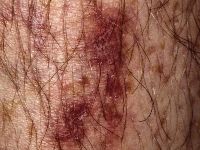 Pretibial pigmented patches