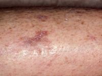 Pretibial pigmented patches