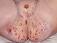 Jacquets erosieve luierdermatitis