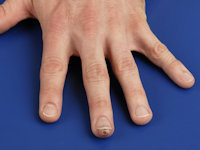 Digital papillary adenocarcinoma