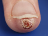 Digital papillary adenocarcinoma