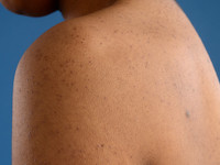 Disseminate and recurrent infundibular folliculitis (DRIF)