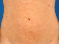 Disseminate and recurrent infundibular folliculitis (DRIF)