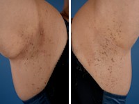 Dowling Degos disease oksels