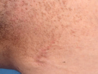 Dowling-Degos, ziekte van