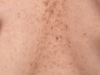 Dowling Degos disease