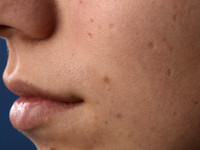 Dowling Degos disease, pittings scars