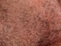 Dowling Degos disease, pigmentatie vagina