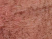 Dowling Degos disease