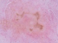 Dowling Degos disease: stervormige bruine pigmentatie bij dermatoscopie