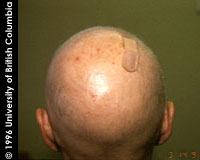 Alopecia areata - diphenciprone