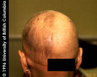 Alopecia areata - diphenciprone