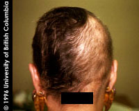 Alopecia areata - diphenciprone