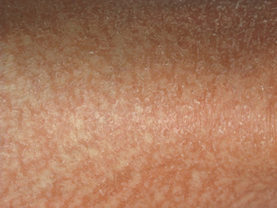 Dry skin in atopic dermatitis