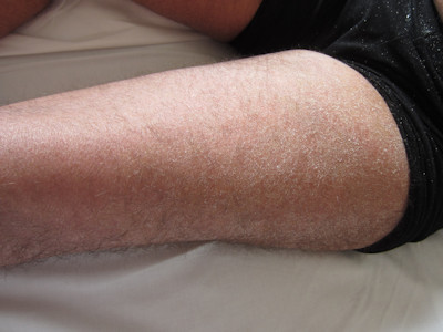 Droge huid bij atopie