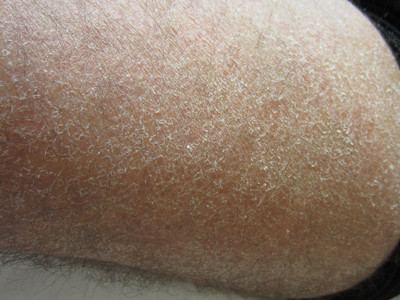 Droge huid bij atopie