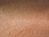 Dry skin with atopic eczema