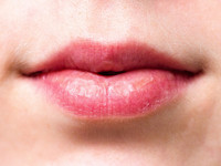 Dry lips