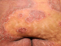Drug-induced IgA dermatosis