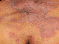 Drug-induced IgA dermatosis
