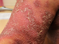 Drug-induced IgA dermatosis