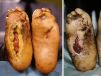 Neuropathische voet bij lepra