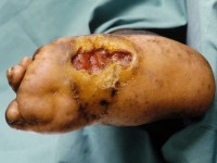 Neuropathische voet bij lepra