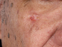 Ductaal eccrien carcinoom