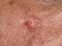 Ductaal eccrien carcinoom