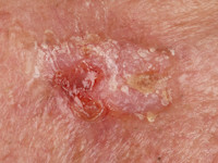 Ductaal eccrien carcinoom