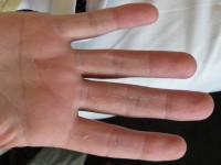 dyshidrosis lamellosa sicca