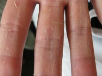 keratolysis exfoliativa