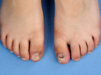 Dyskeratosis congenita