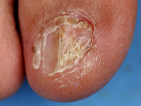 Dyskeratosis congenita