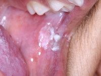 Dyskeratosis congenita