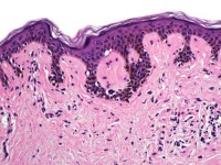 Histologie van een dysplastische naevus