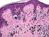 Histologie van een dysplastische naevus