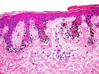 Histologie van een dysplastische naevus