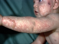 Dystrophia bullosa hereditaria