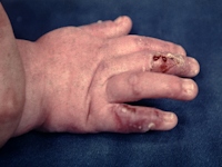 Dystrophia bullosa hereditaria