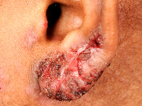Cutane TBC (lupus vulgaris) van de oorlel