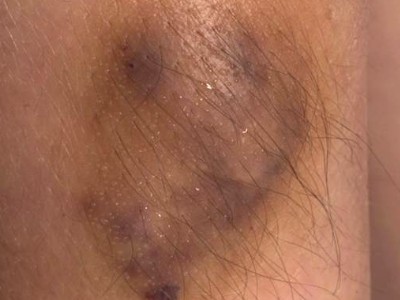 Eccrien angiomateus hamartoom