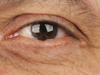 Eccrien hidrocystoma