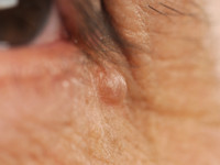 Eccrien hidrocystoma