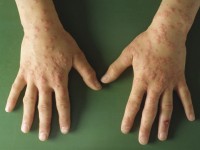 Erythema exsudativum multiforme (EEM), ontstaan na en uitgelokt door orf (ecthyma contagiosum)