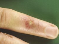 Erythema exsudativum multiforme (EEM), ontstaan na en uitgelokt door orf (ecthyma contagiosum)