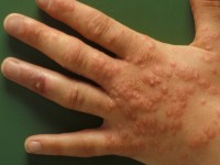 Erythema exsudativum multiforme (EEM), ontstaan na en uitgelokt door orf (ecthyma contagiosum)