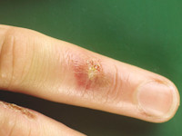 Orf (ecthyma contagiosum)