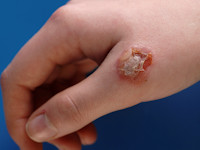 Orf (ecthyma contagiosum)