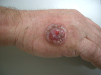 Orf (ecthyma contagiosum)